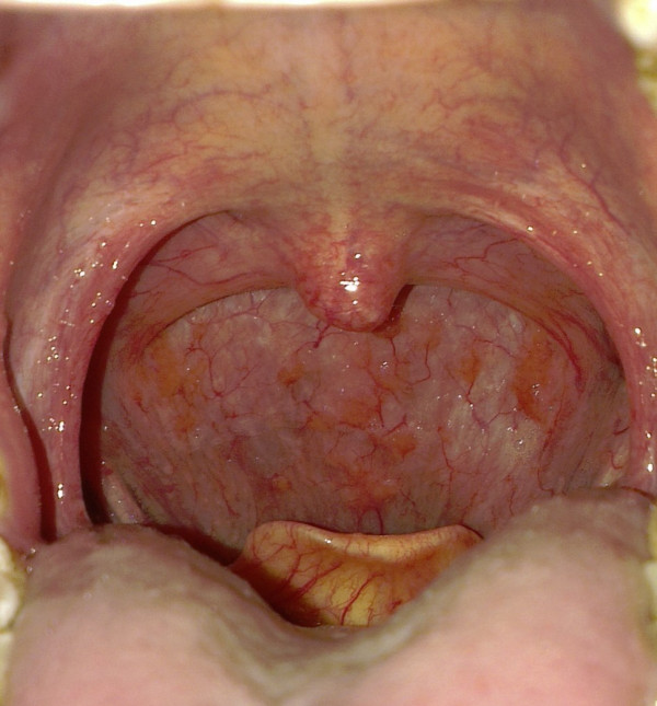 舌头根后面有个 类似小舌头的东西.