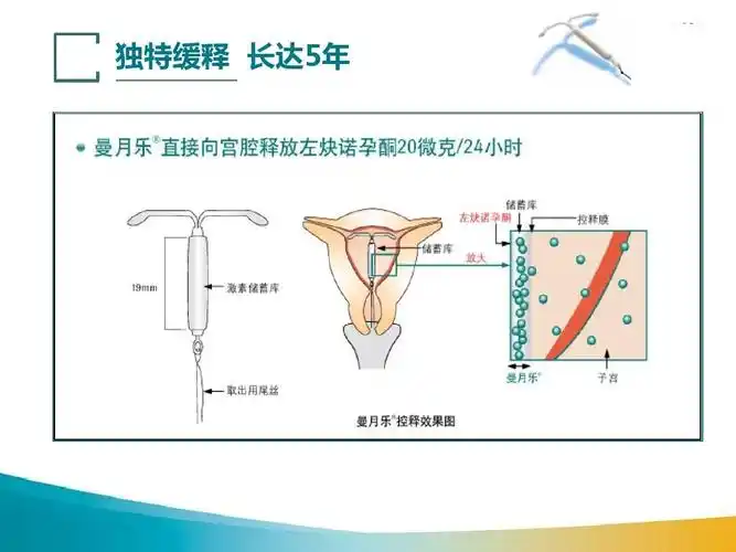 ius概述:避孕机理和安全性ppt