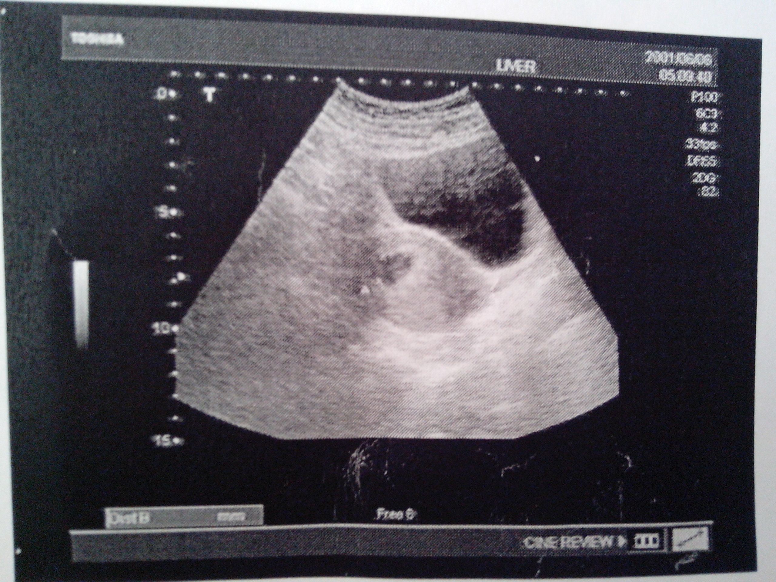 这是我怀孕6周6天的黑白b超图,有孕囊吗?求帮助