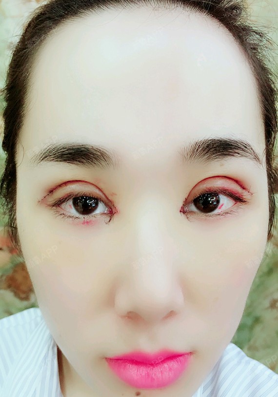 氧气xv77g切开双眼皮第6天美丽日记