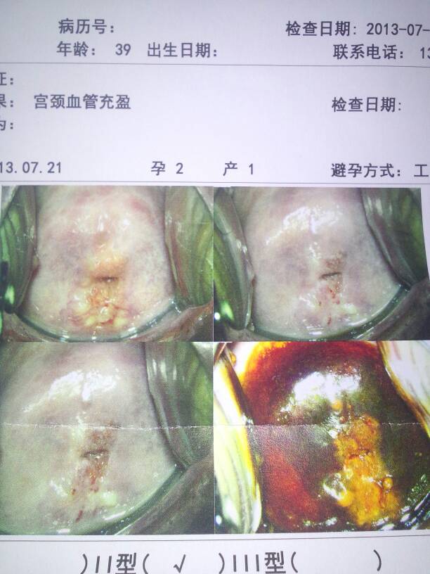 病情分析: 你好,依据你描述的症状,做阴道镜检查患宫颈纳氏腺囊肿
