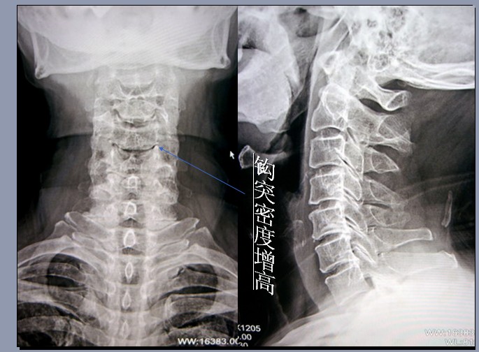 钩椎关节的介绍