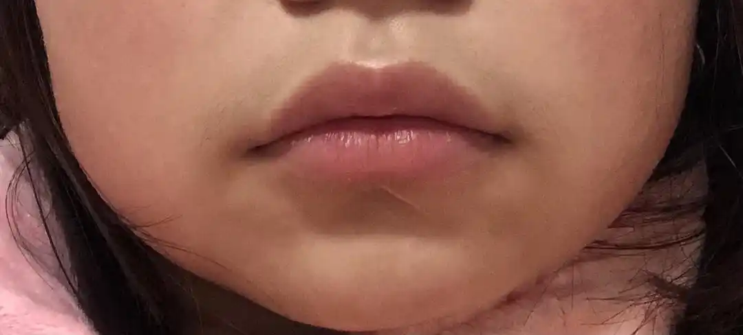 嘴角向下怎么办