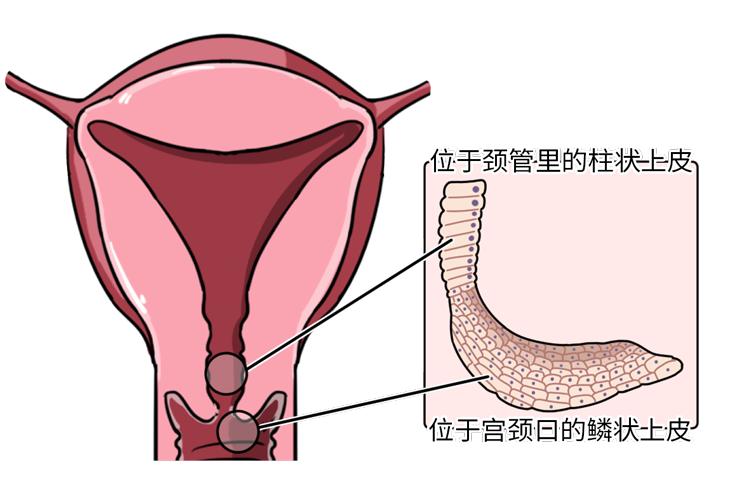 宫颈有两种"皮肤"何况这糜烂还发生在宫颈上就自带吓人属性光糜烂两个