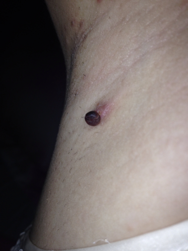 问:胳肢窝好几年前长了个疙瘩,以前不疼不痒,,今年