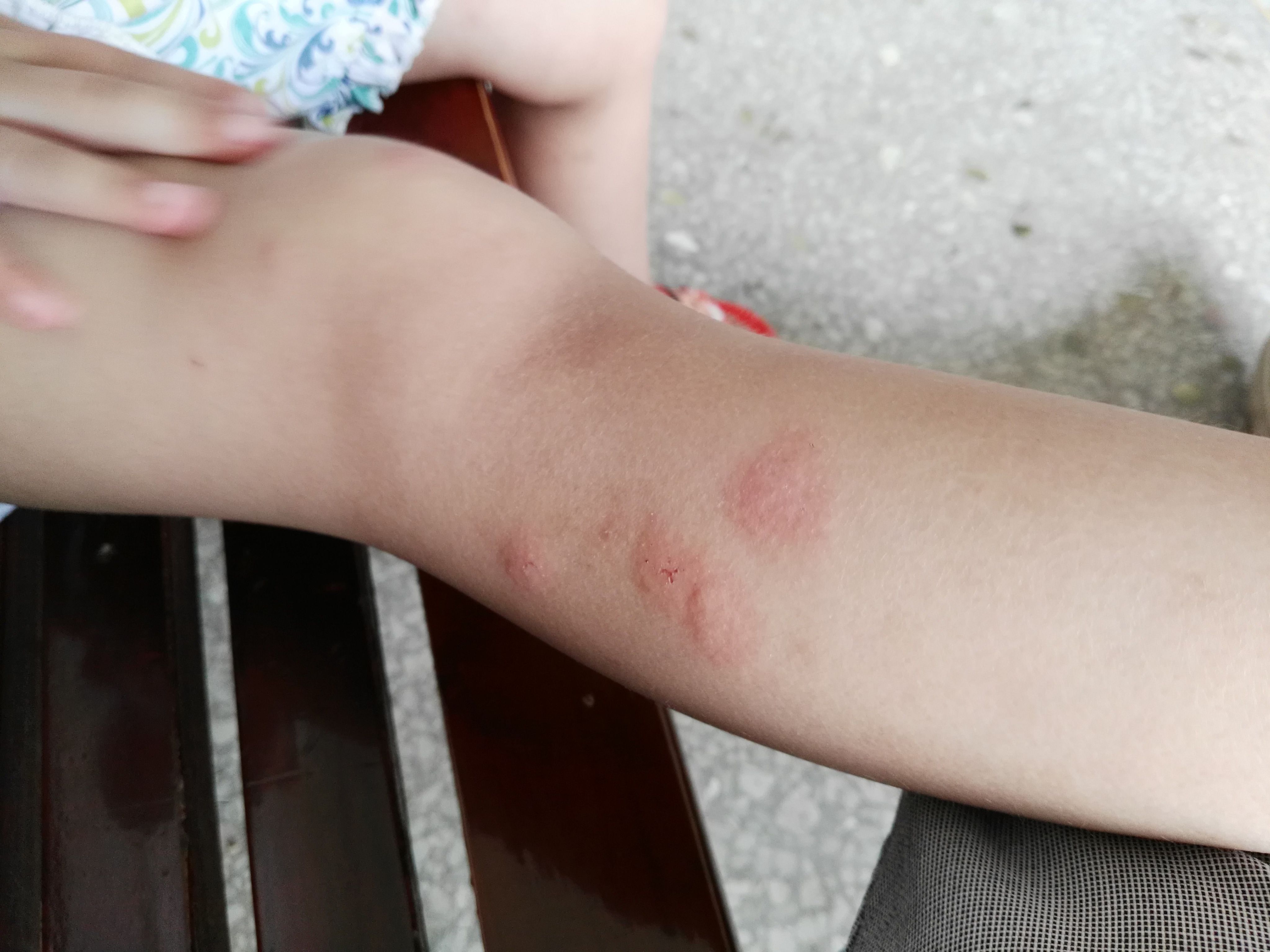 夏天被蚊子咬奇痒无比,抓了之后红肿一大片,求救用什么可以快速止痒