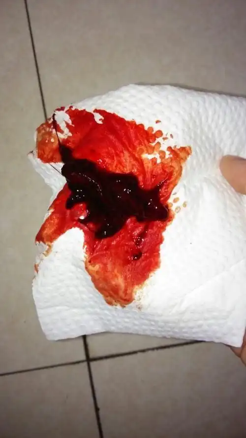 月经期间每次都有这样的血块来月经有血块吃什么好月经流出来的血块