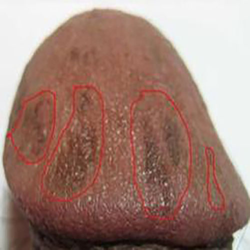 念珠菌性龟头炎图片