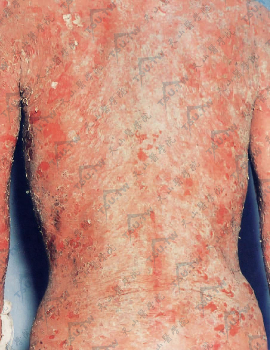 天疱疮的病因,症状,诊断与治疗