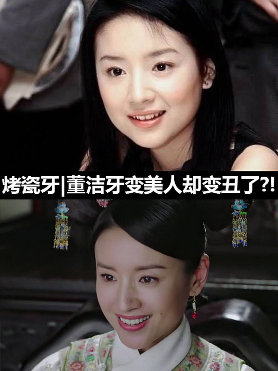 董洁做完烤瓷牙变美了但嘴也变凸了,算是整牙失败了吗_圈子-新氧美容