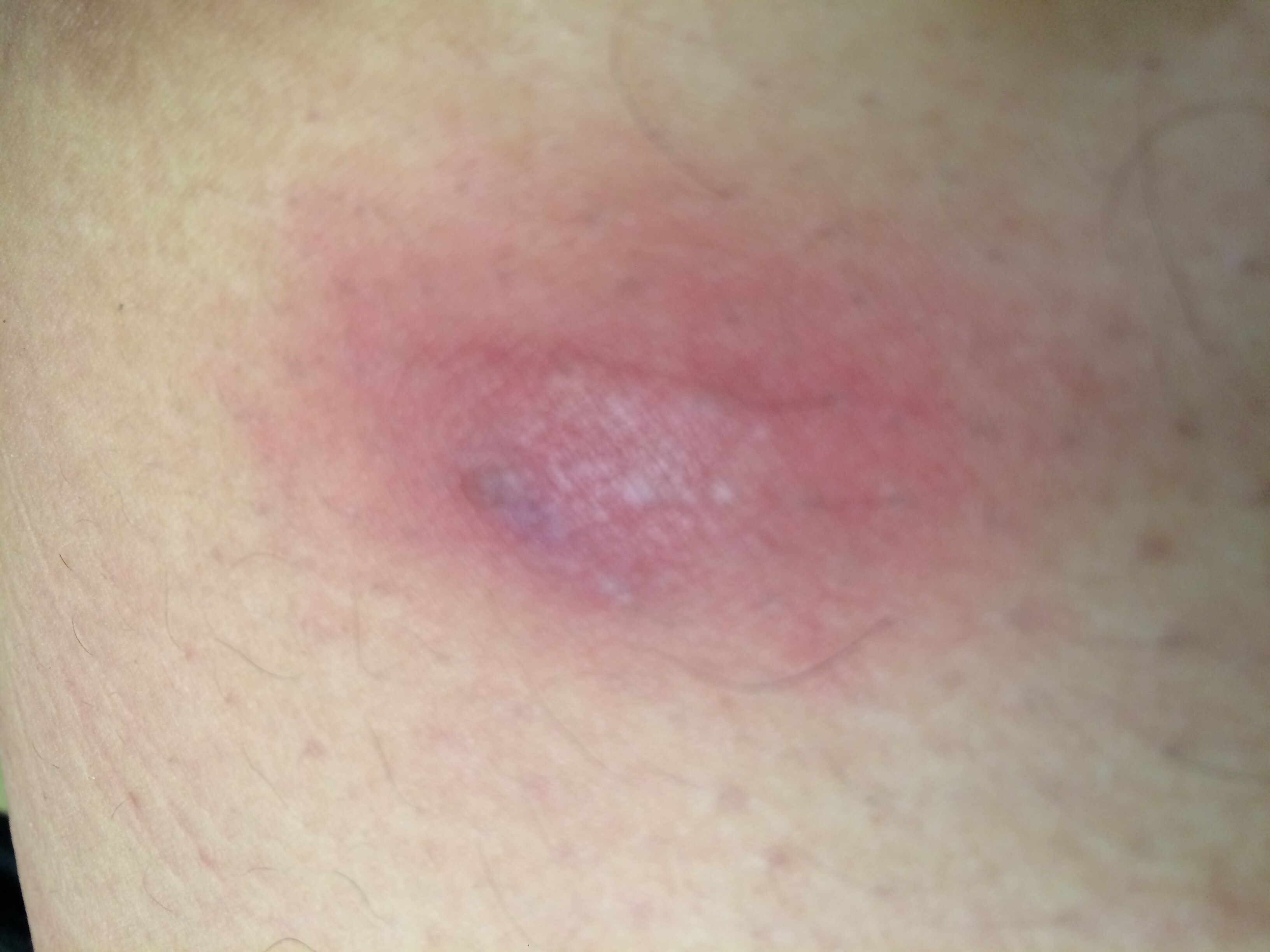 最近大腿根内侧起了一个包,开始不大,不疼.最近几天发现变大了