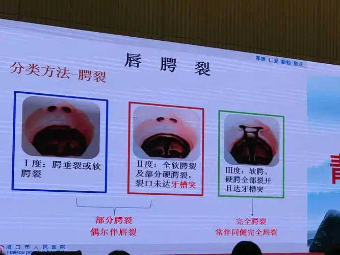 唇腭裂超声检查一海南