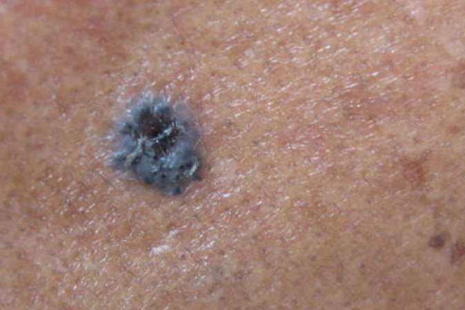 怀疑是皮肤癌的图片