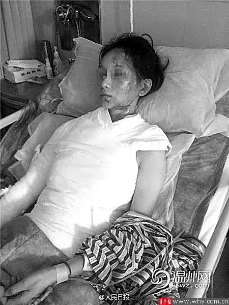 女顾客遭服务员开水浇头 涉事17岁嫌犯被刑拘