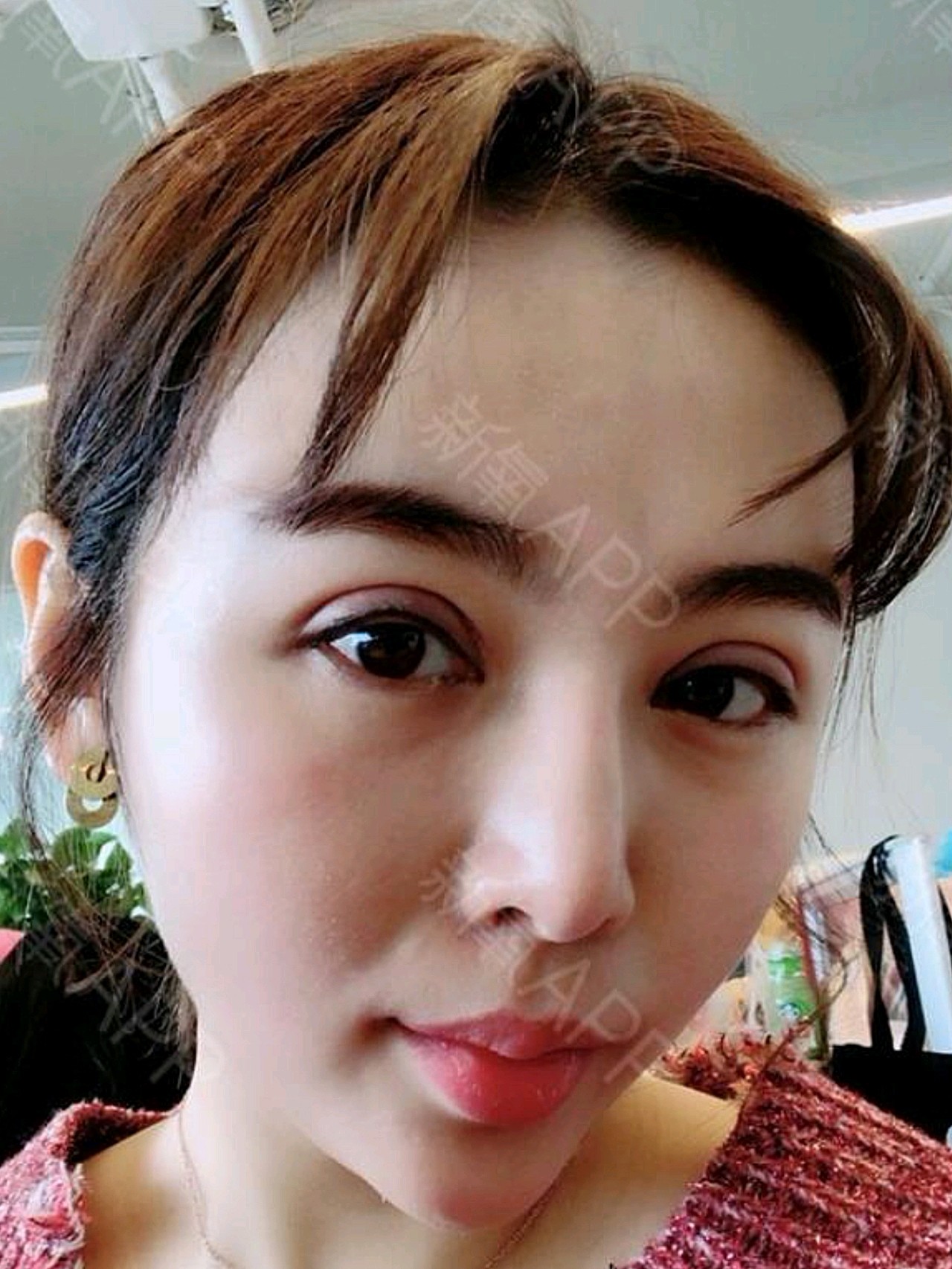 【切开双眼皮术后第10天】