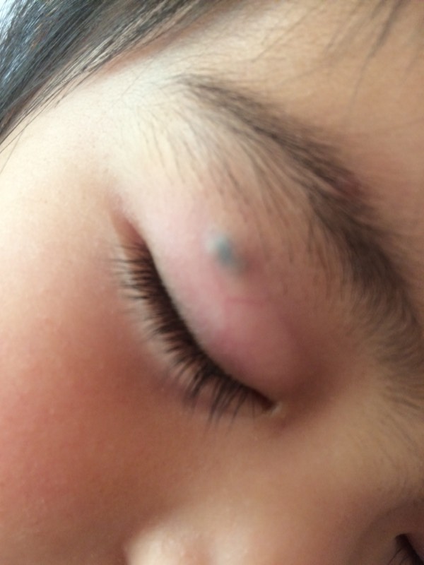 我家宝宝今年2岁11个月,从年后发现眼皮上长了个疙瘩,不是很大,到现