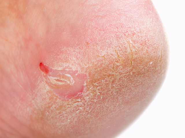 双脚是肝脏健康的"晴雨表",连续出现这3种异常,肝病来袭