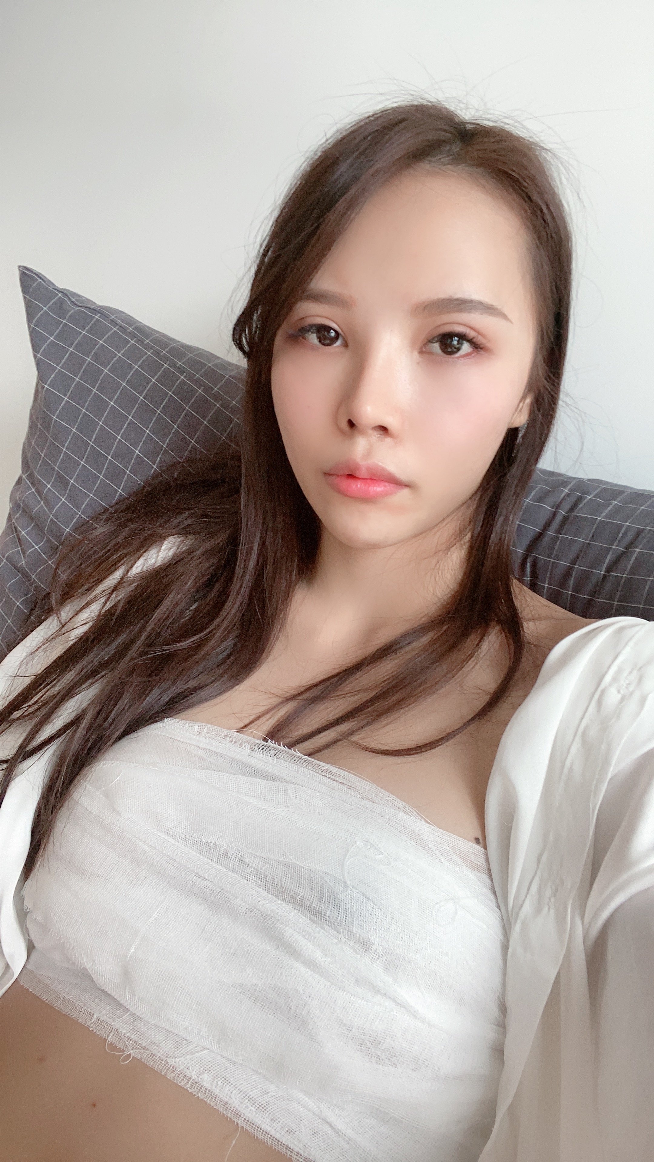 【假体丰胸术第4天】