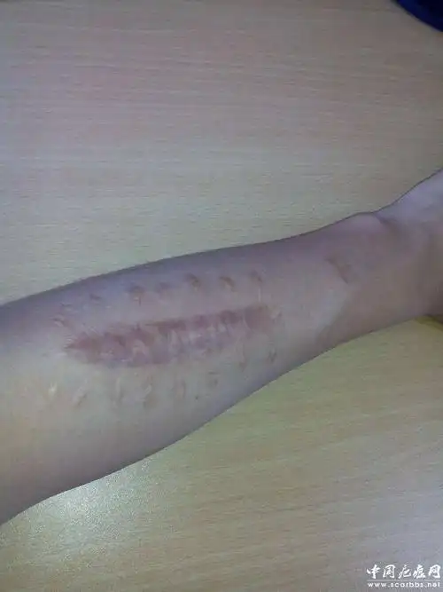 萎缩性瘢痕的说明