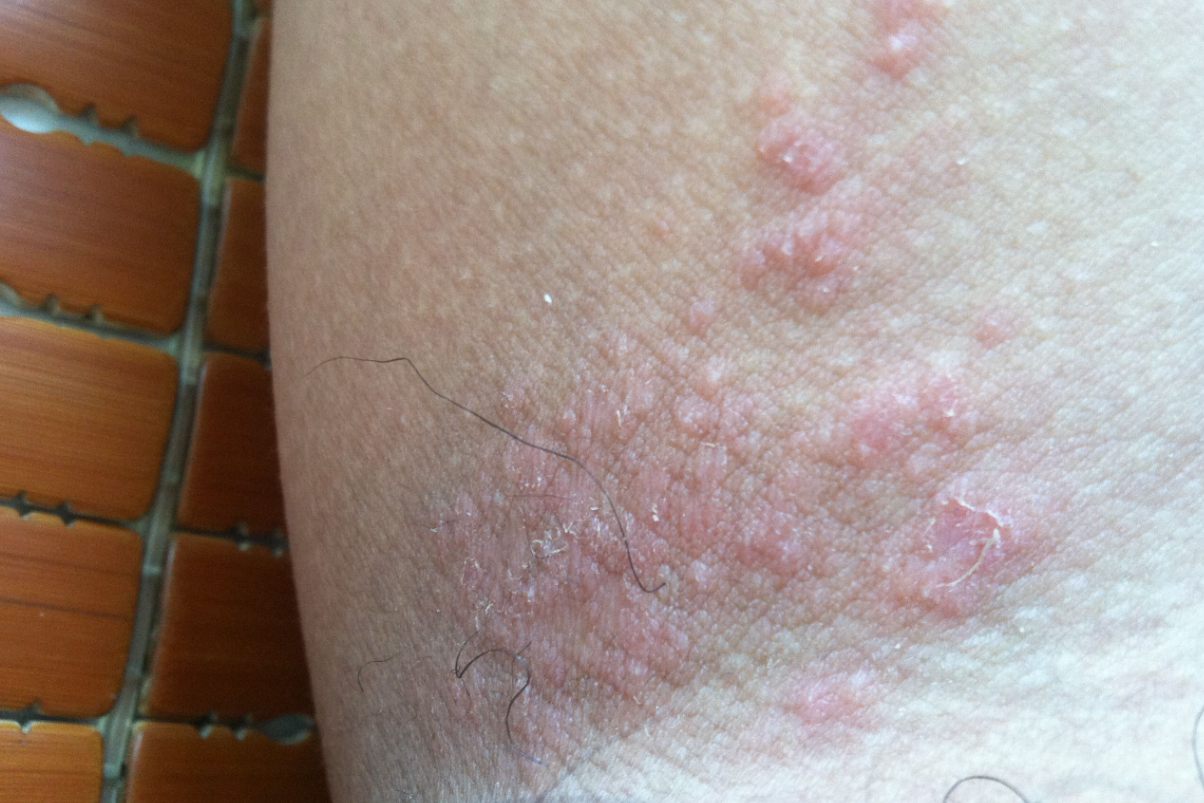 接触刺激性物品的皮肤表面,出现红色丘疹,有时还会形成水疱,伴随瘙痒