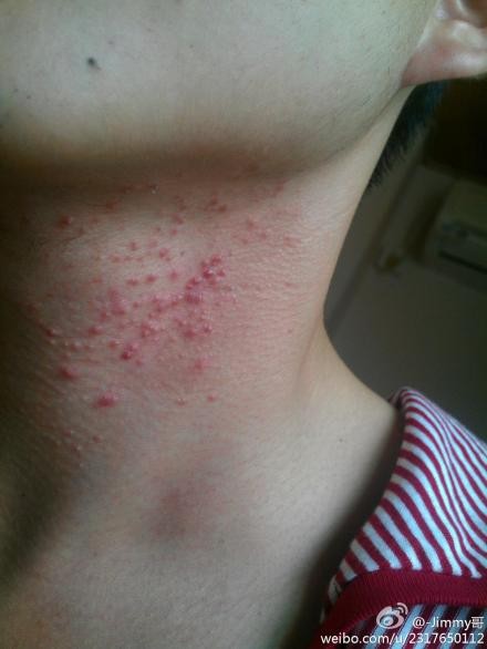脖子上长这些东西,洗澡的时候热水碰到会有点痛?怎么回事啊?求解决!