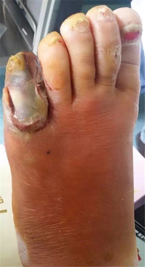 糖尿病足症状