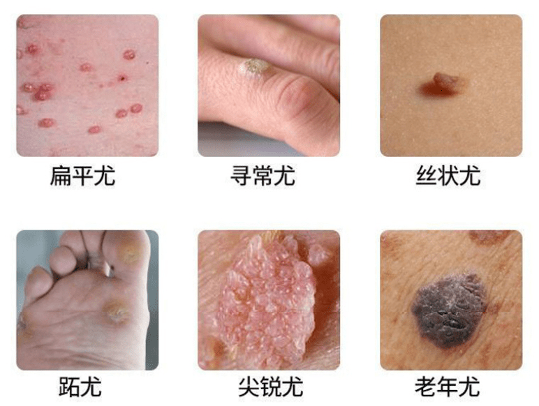 要注意的是,跖疣是会传染的!