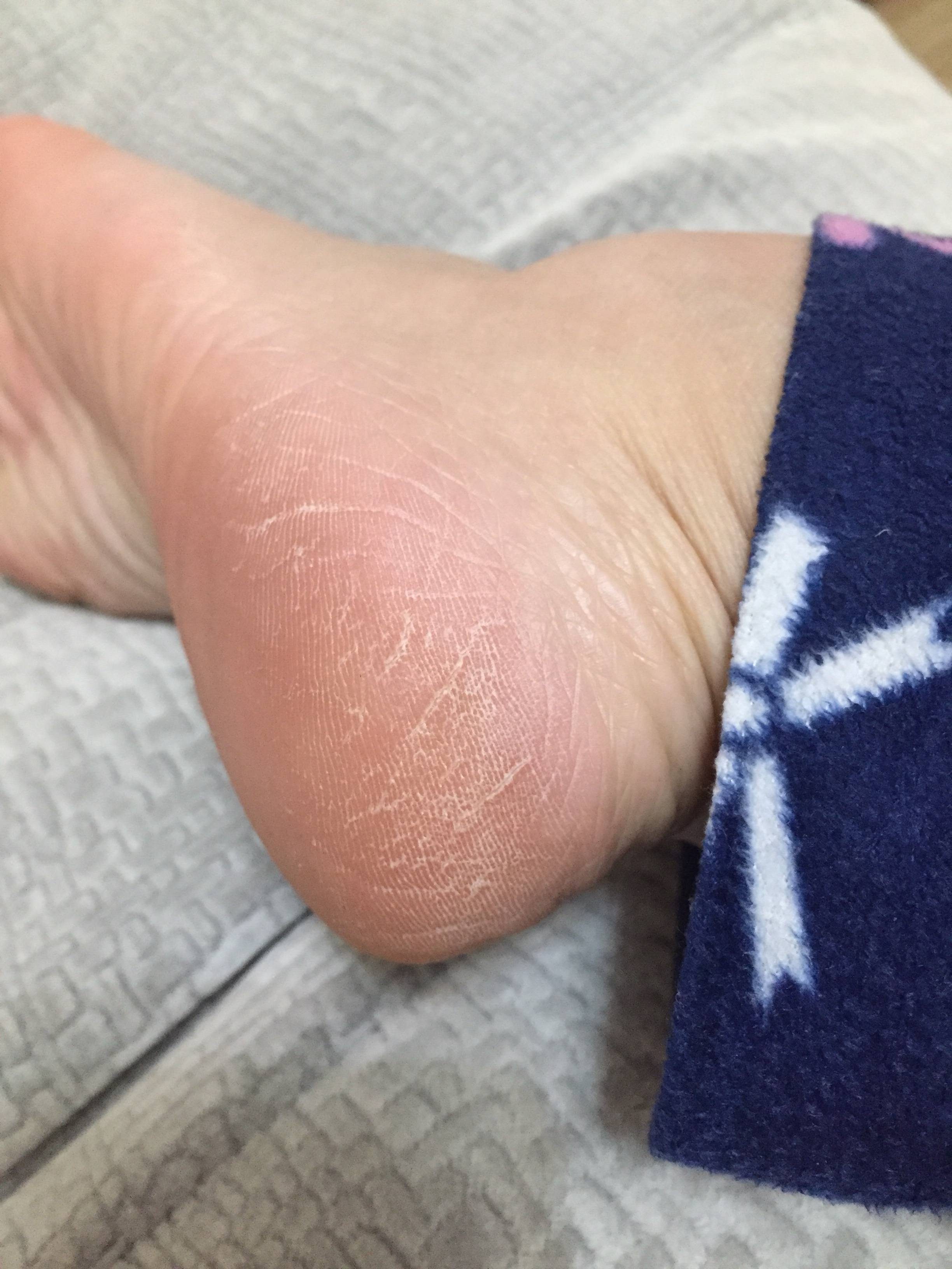 女人脚后跟干裂,怎么办?_问题_都会_皮肤