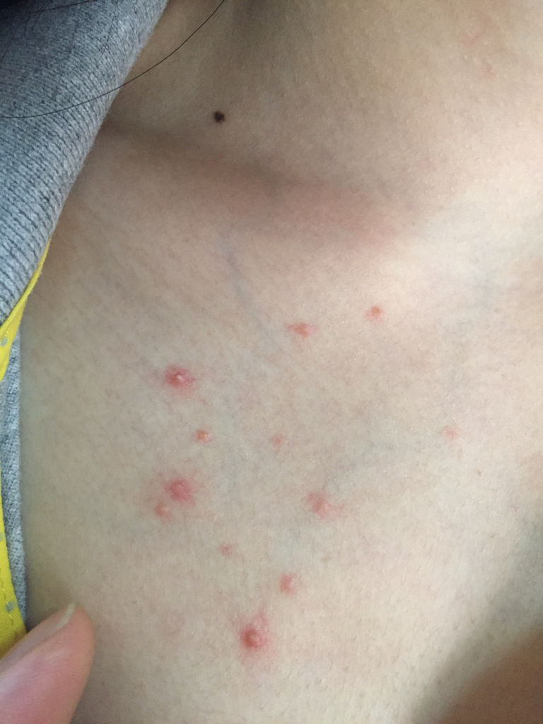 这几天胸口突然长了好多这样一粒粒的,请问大神们我这是怎么了?