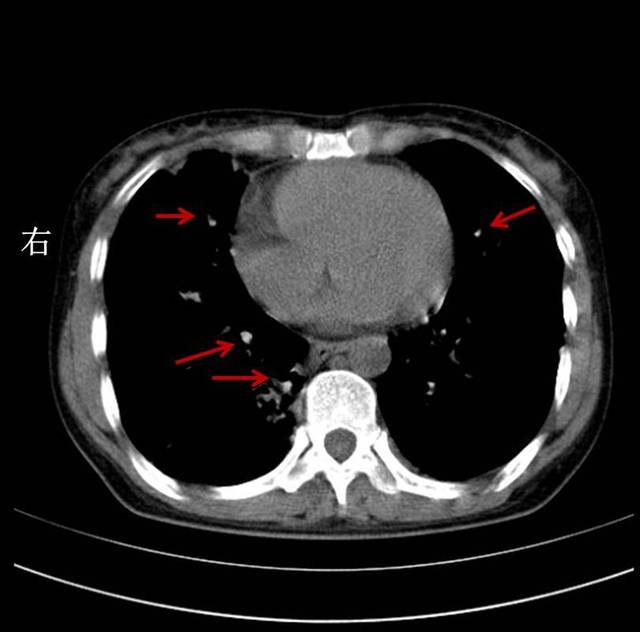 双肺可见多个纤维空洞,条索状,斑点状影,病灶有钙化.