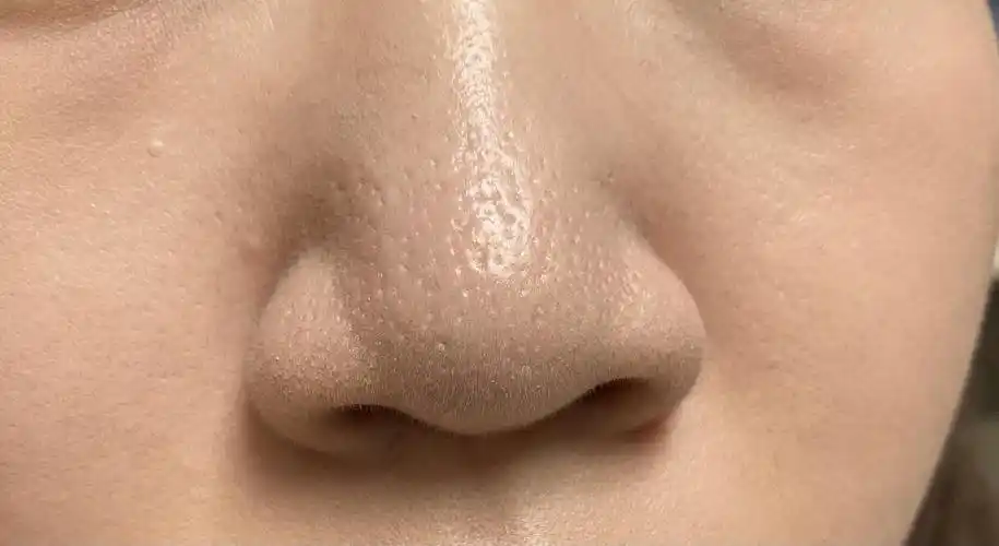 鼻子毛孔粗大怎么办