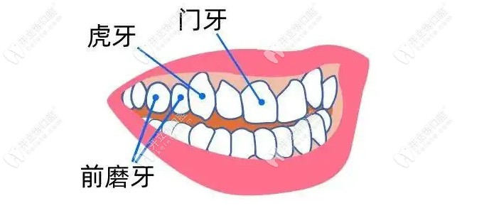长在牙龈上的虎牙可以拔掉吗?想知道如果拔掉有什么影响