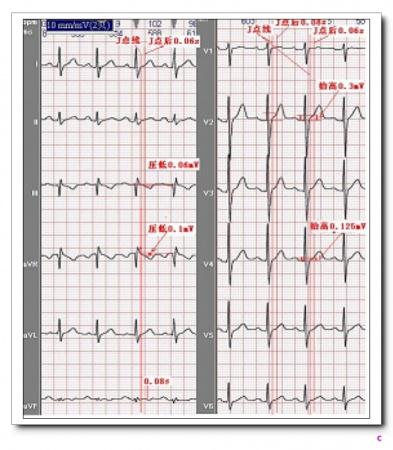 山羊老师课程常见心电图基础知识讲座第十讲——st段分析