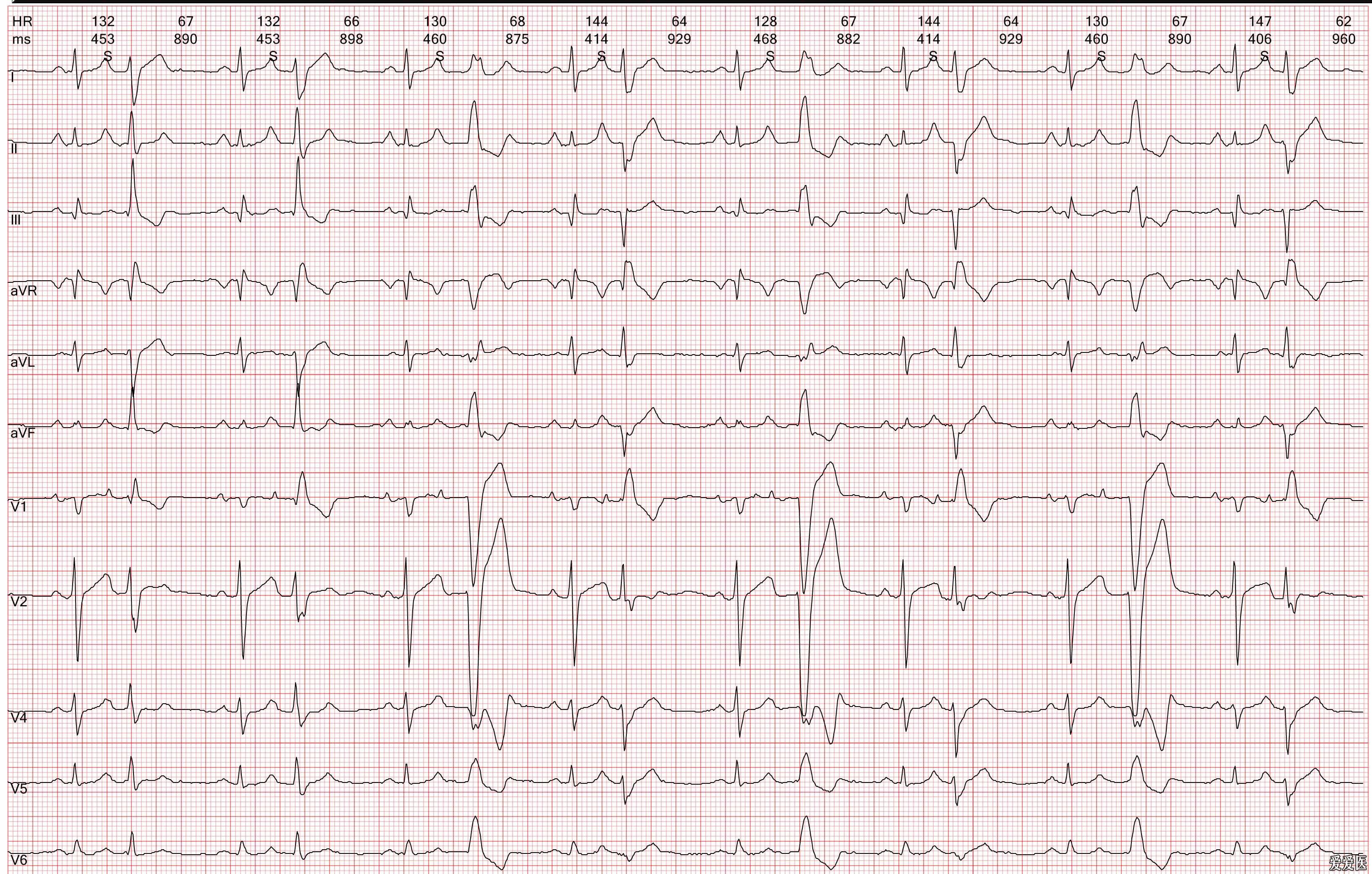 心电图欣赏-善变的qrs波群