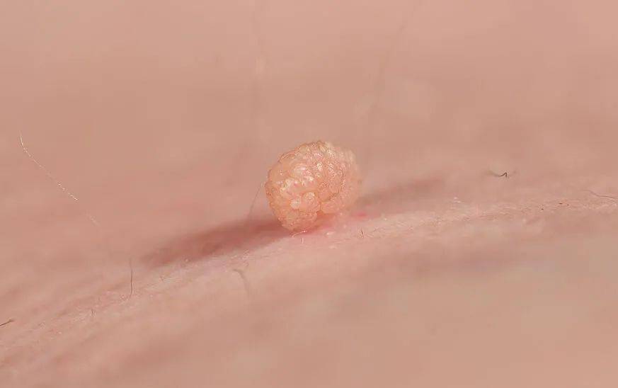 身上长了肉疙瘩要紧吗医生建议做了这件事儿才放心