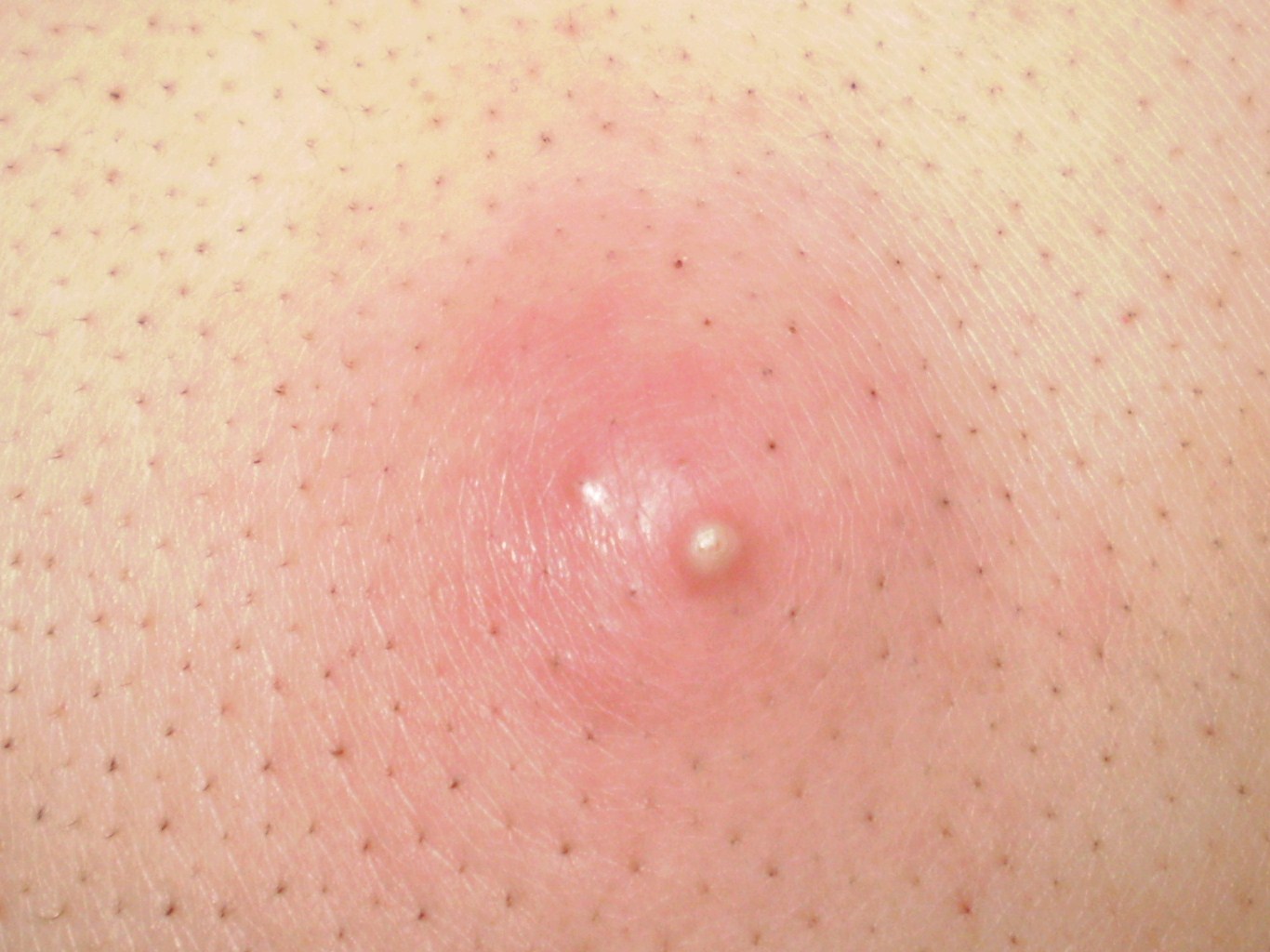 粉瘤挤出来是啥样图片