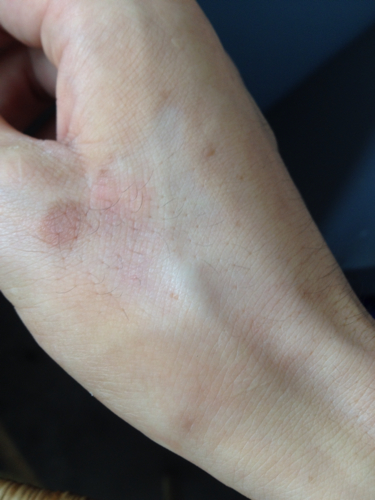 1个月前,右手虎口区长局限性神经性皮炎(见第1张图片),局部注射