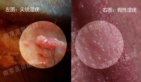 "上面出现一些颗粒样的丘疹或增生,的确有可能是性传播疾病尖锐湿疣
