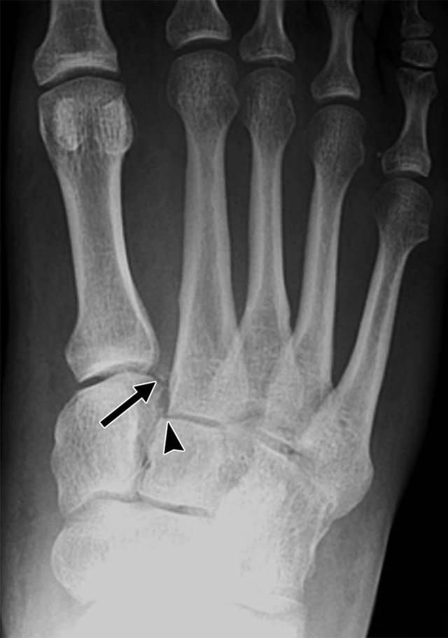 "骨裂"跟"骨折"一样么?听听骨科专家怎么说!