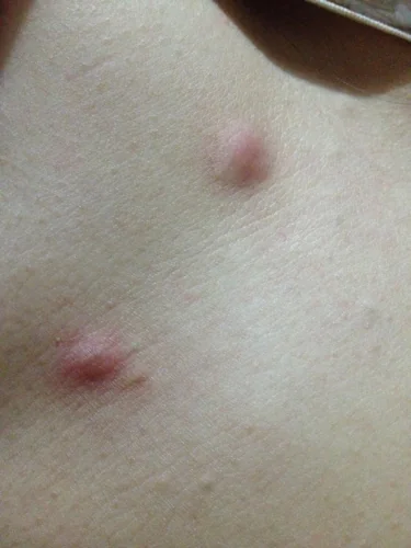 请各位二十来岁的美女帮忙回答你们是不是也有这种乳房小肉颗啊?