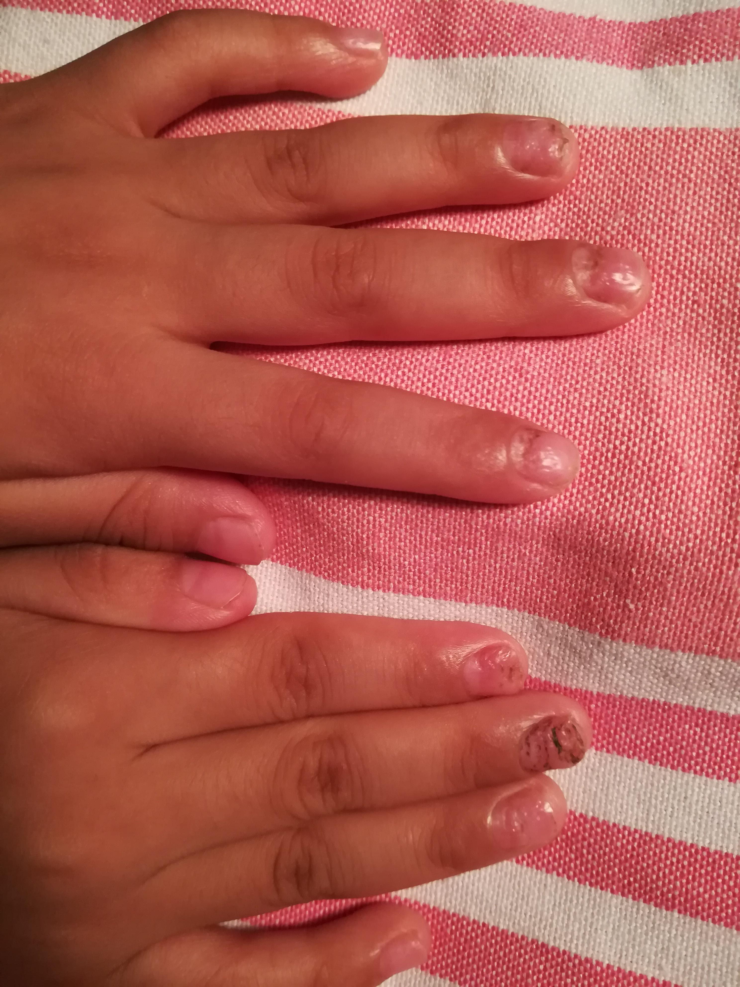 小儿指甲凹凸不平求诊治