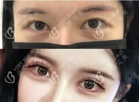 韩国可来熙朴圣勋院长眼综合术前术后对比