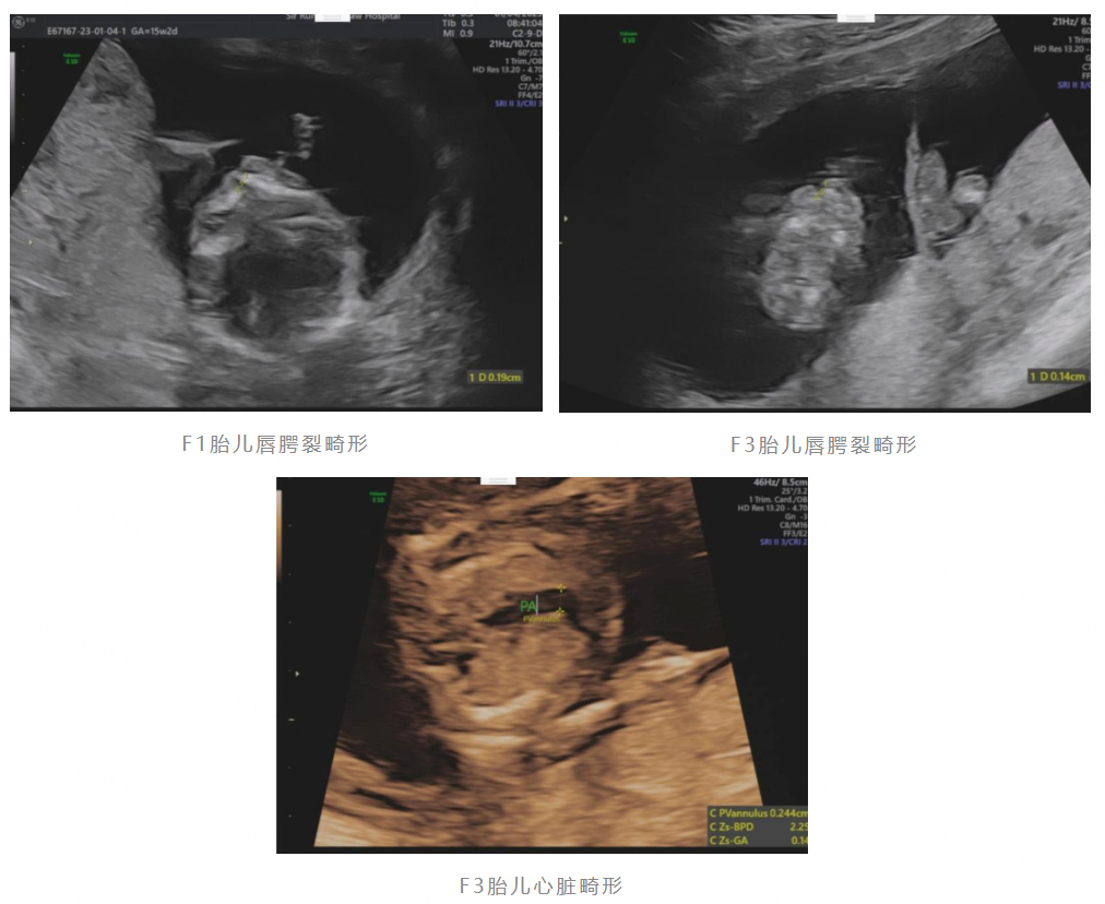 健康胎儿与畸形胎儿同卵双生!|邵逸夫_新浪财经_新浪网