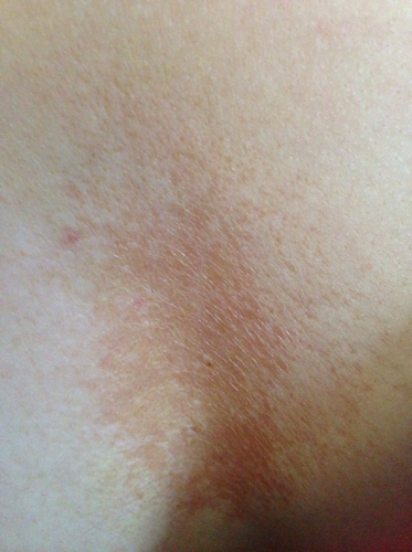 女28未婚,上个星期胸口乳沟正中长了四颗红色点点,有点像痘痘,但又痛