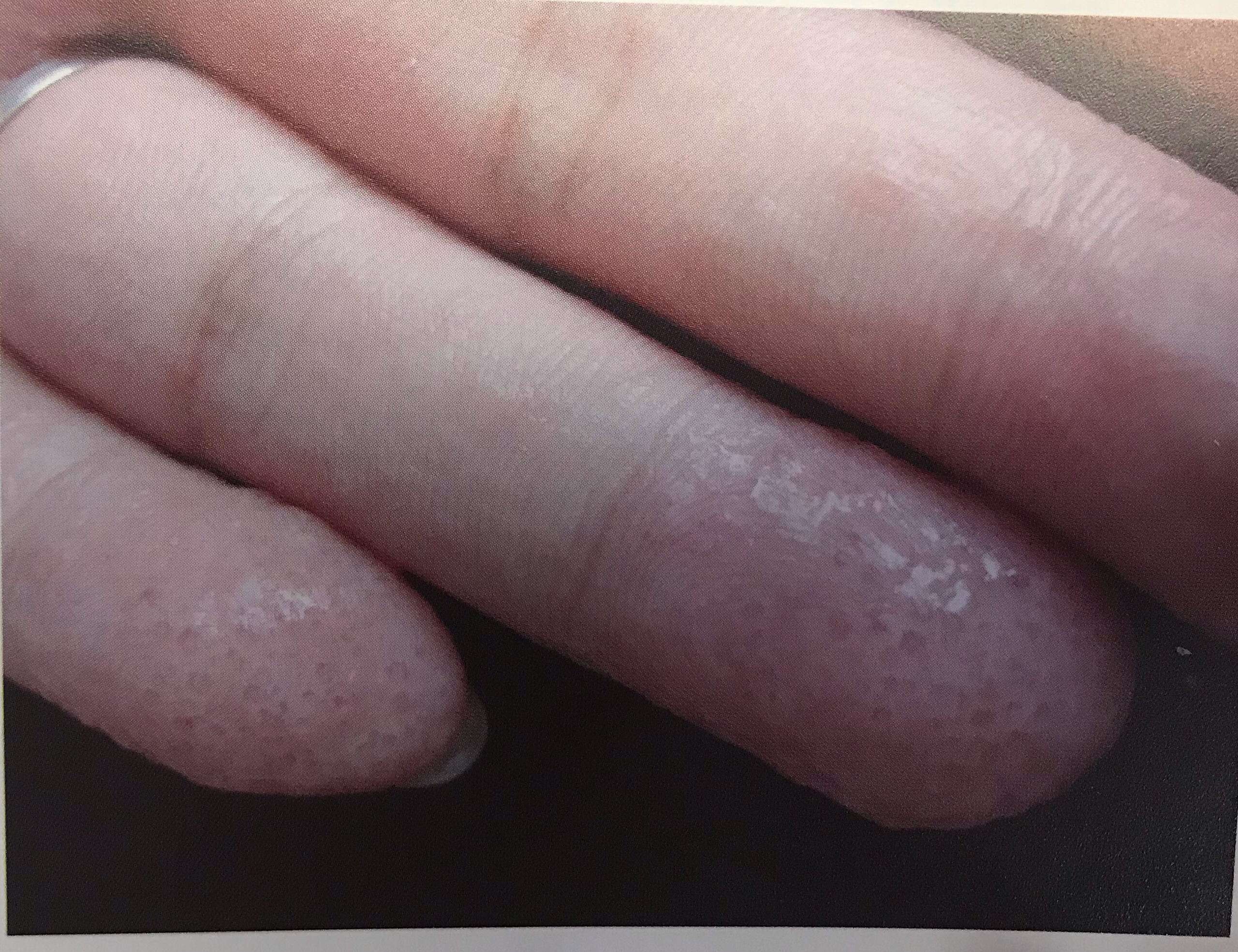 「汗疱疹」也称「出汗不良性湿疹」,是复发性水疱性皮肤病.