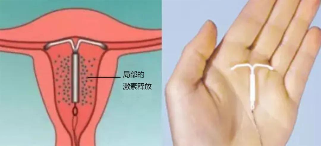 慈海医疗||女性朋友的福音——神奇的曼月乐环_子宫