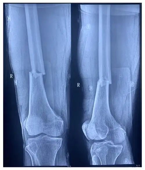 逆行髓内钉治疗双侧股骨干骨折